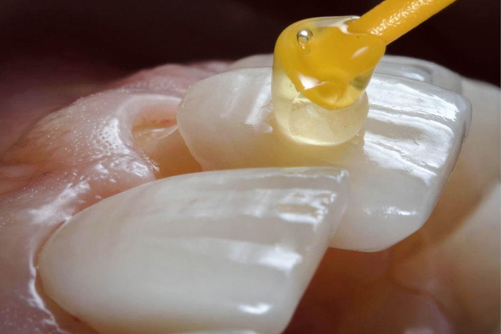 close up of a veneer being placed onto a tooth
