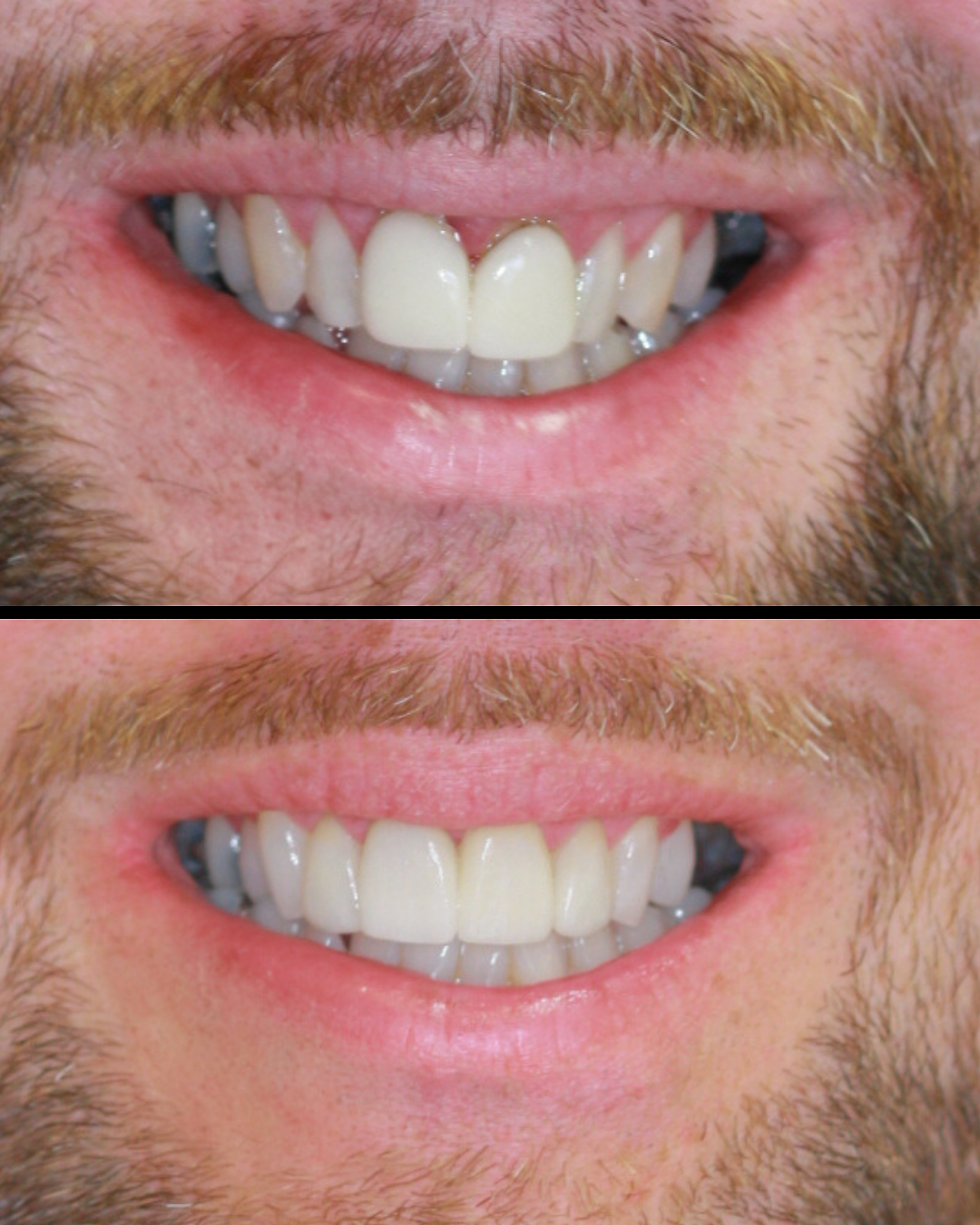 Porcelain Veneers 1