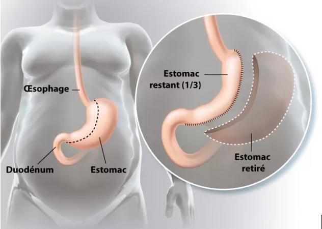 Sleeve gastrectomie