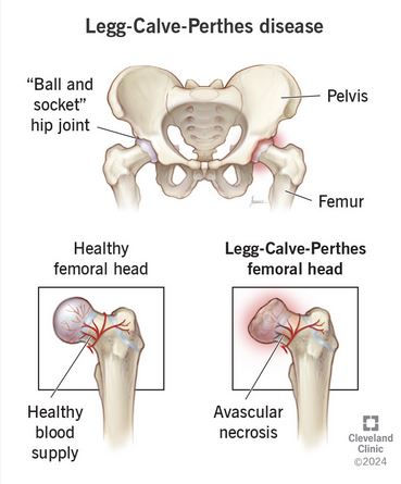 Maladie de Legg-Calvé-Perthes