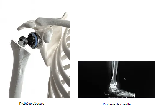 Prothèse d'épaule et prothèse de cheville