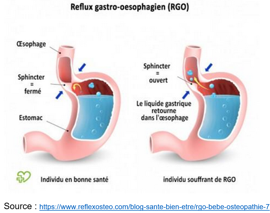 Reflux gastro-oesophagien