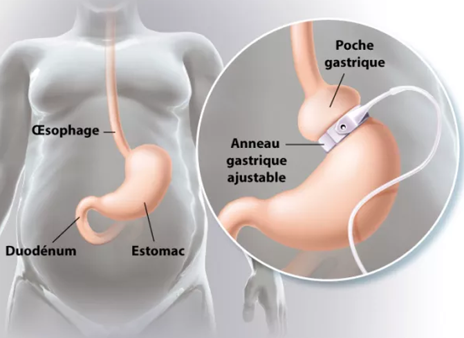 Anneau gastrique