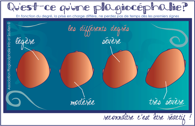 Qu'est-ce qu'une plagiocéphalie