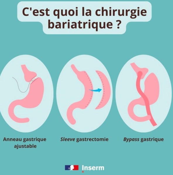 Méthodes de chirurgie bariatriques