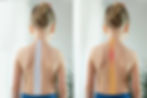 Ostéopathie et scoliose