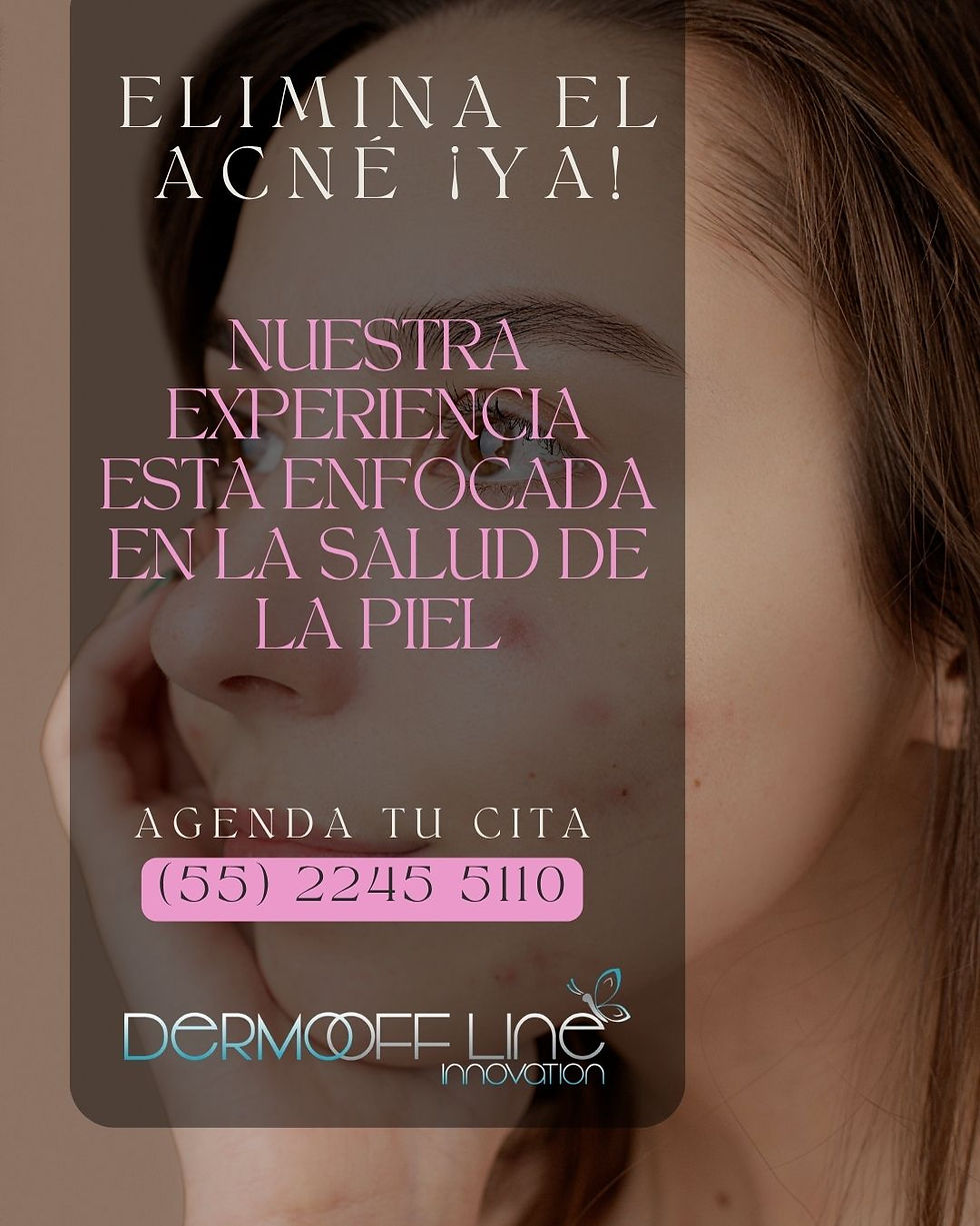 ELIMINA EL ACNÉ ¡YA!