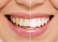 Dentista Clareamento Dental_edited.jpg