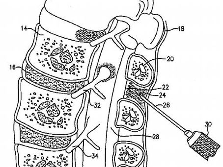 18 - Perispinal Etanercept (aka Enbrel)