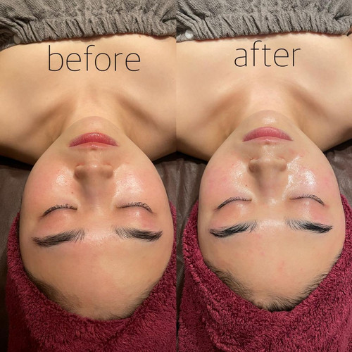 USA Seller-CIVASAN Varocobin C Professional Treatment Kit