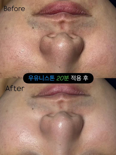 USA Seller-Pharmesthetics Conapidil Uyuni Stone Sebum Care Kit