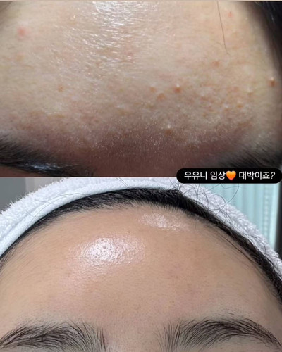 USA Seller-Pharmesthetics Conapidil Uyuni Stone Sebum Care Kit