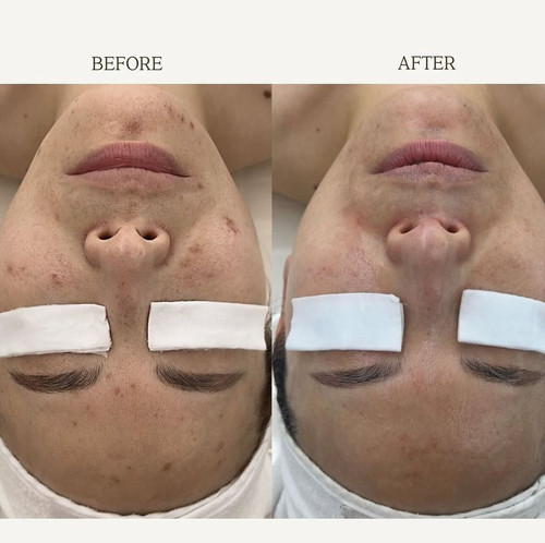 USA Seller-CIVASAN Varocobin C Professional Treatment Kit