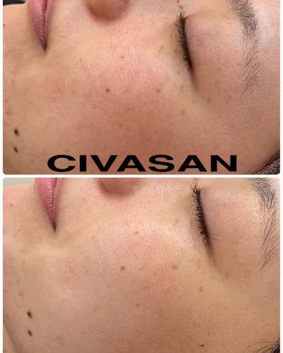 USA Seller-CIVASAN Varocobin C Professional Treatment Kit