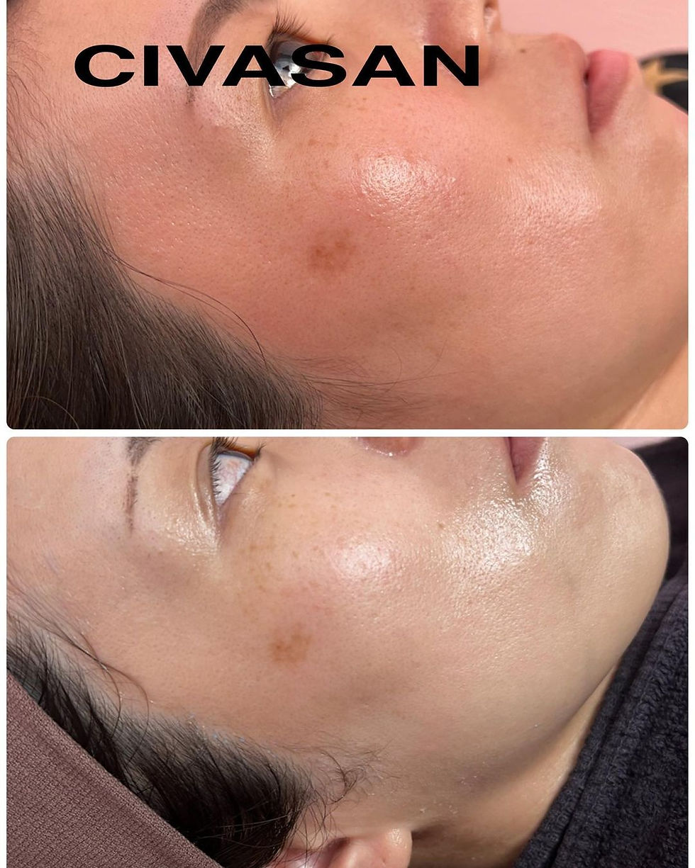 Thumbnail: CIVASAN Varocobin C Professional Treatment Kit