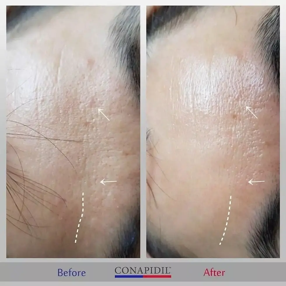 Thumbnail: Pharmesthetics Conapidil Cemenzal High Potency Cream