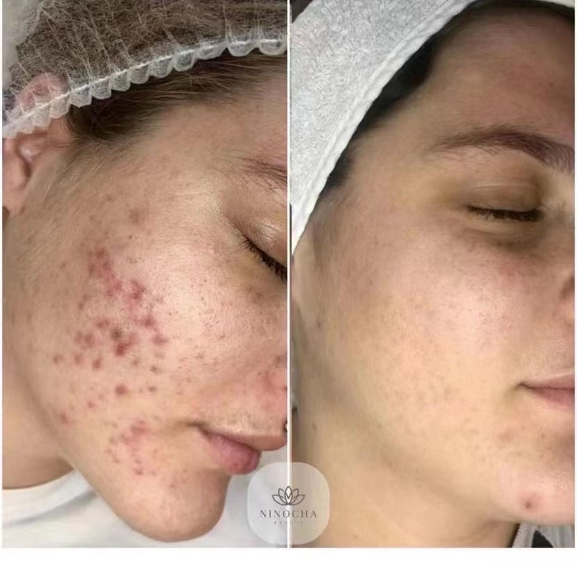 Thumbnail: Selvert Thermal Peeling Acid