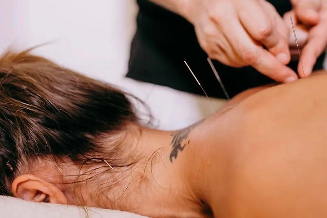 acupuncture1.jpg