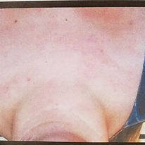 acne after.jpg