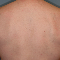 hair removal male back after.png