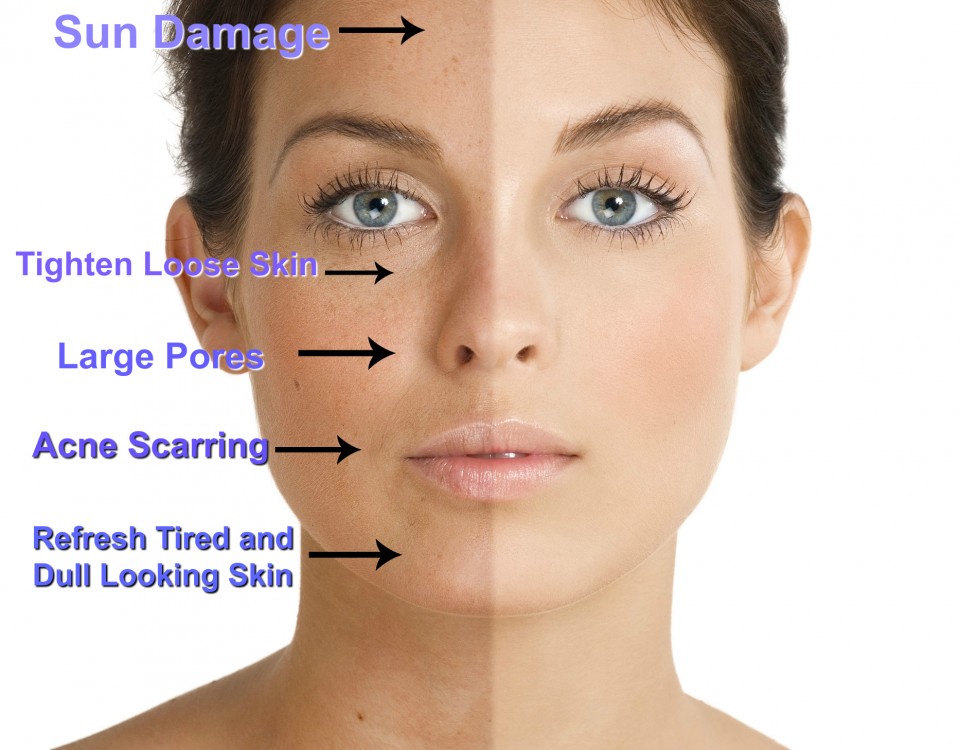 Image result for skin bleaching treatment"