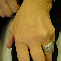 brown spots hand after.png