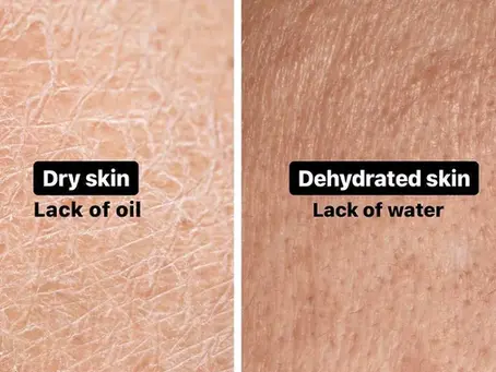 Do you have Dry or Dehydrated skin?