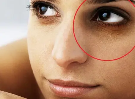 Dark Circles, and how to get rid of them
