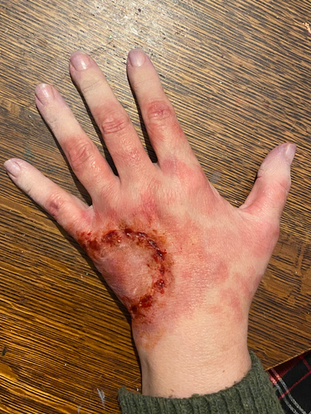 Wounds