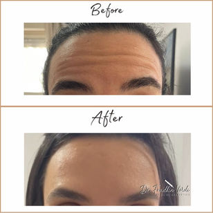 בוטוקס מצח 8.7 2.jpg