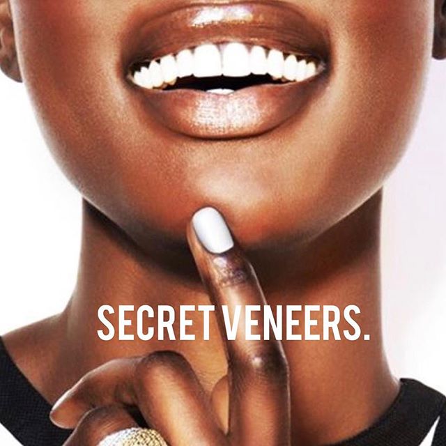 Secret Veneers Clip On Veneers