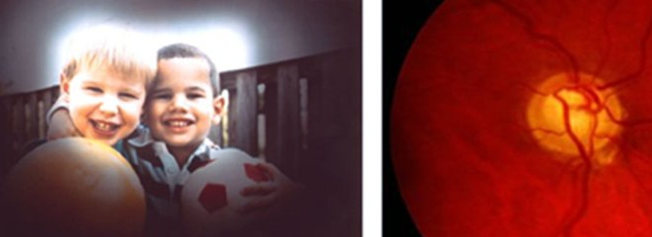 Vision-dun-patient-atteint-de-glaucome-a-gauche-Le-champ-visuel-est-reduit-Image-105673594