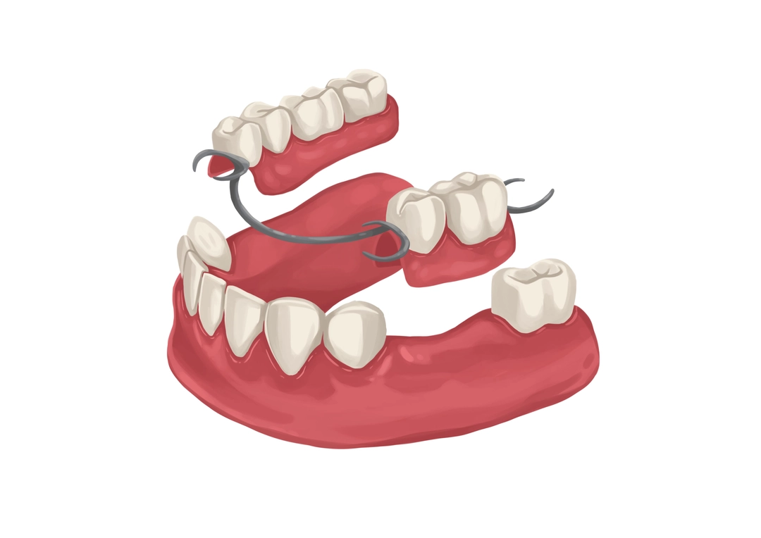 metal-partial-dentures-for-lower-arch-technical-picture_50729002598_o.webp