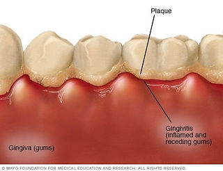 Placa bacteriana