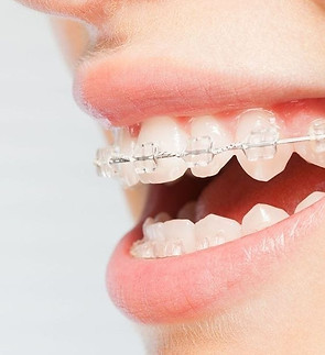 Ortodoncia brackets de zafiro. Clínica dental Novadent Nicaragua