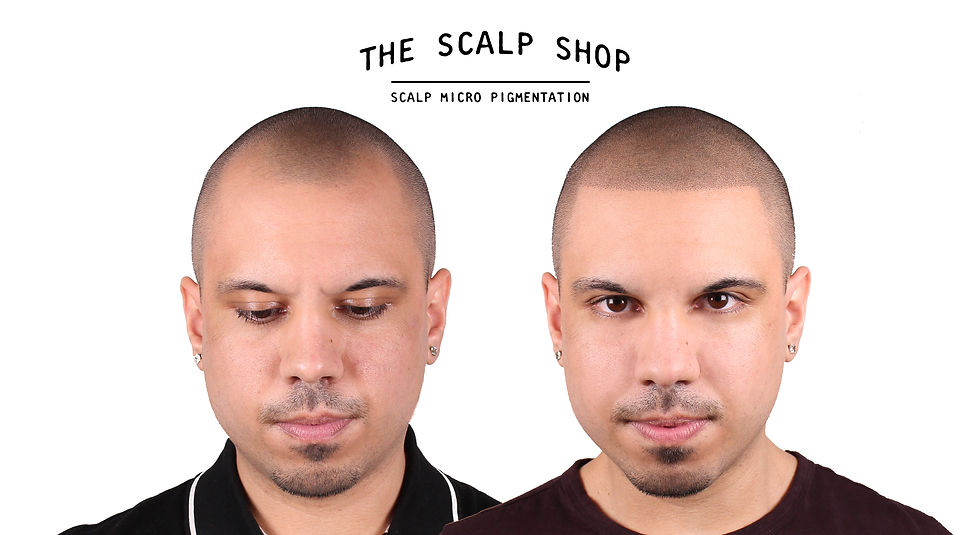 SMP Before & After Front View