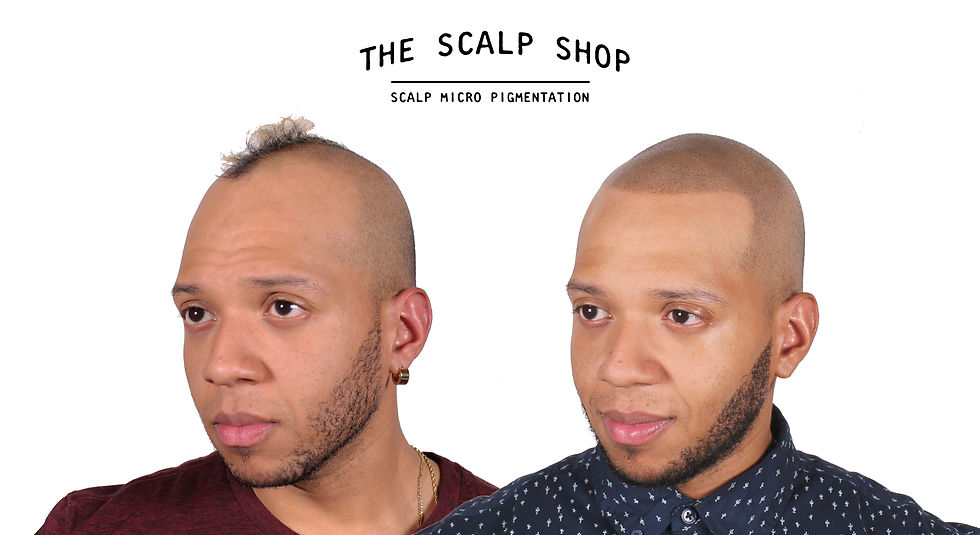 SMP Before & After Side Profile View