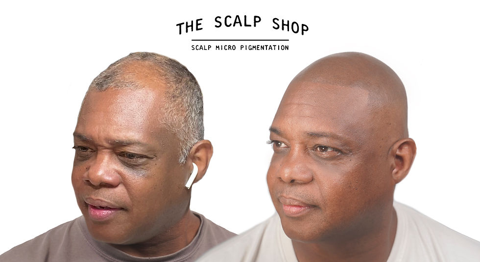 Ernest Before + After SMP Left