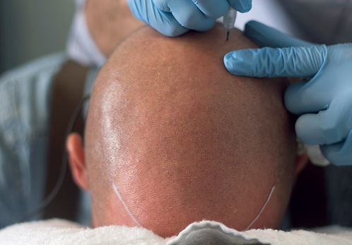 The Scalp Shop | Hair Tattoo - The #1 Baldness, Alopecia, Thinning Hair & Scarring Solution
