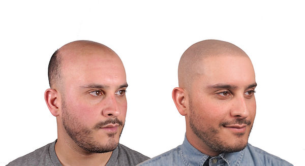 natural hairline smp bald.jpg