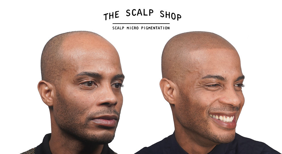 Vernard Before + After Scalp Micro Pigmentation Right Side