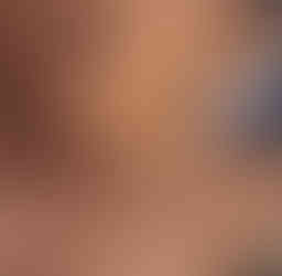 Torticolis pédiatrique aussi appelé pseudo-tumeur créant une bosse au cou de votre nouveau-né