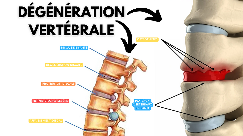La sténose pouvant être le résultat de dégénérescence articulaire (arthrose) ou discale (hernie) et faire compression sur les nerfs sortant de la moelle épinière provoquant un syndrome de la queue de cheval