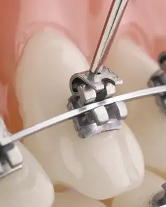 Braces 1.webp
