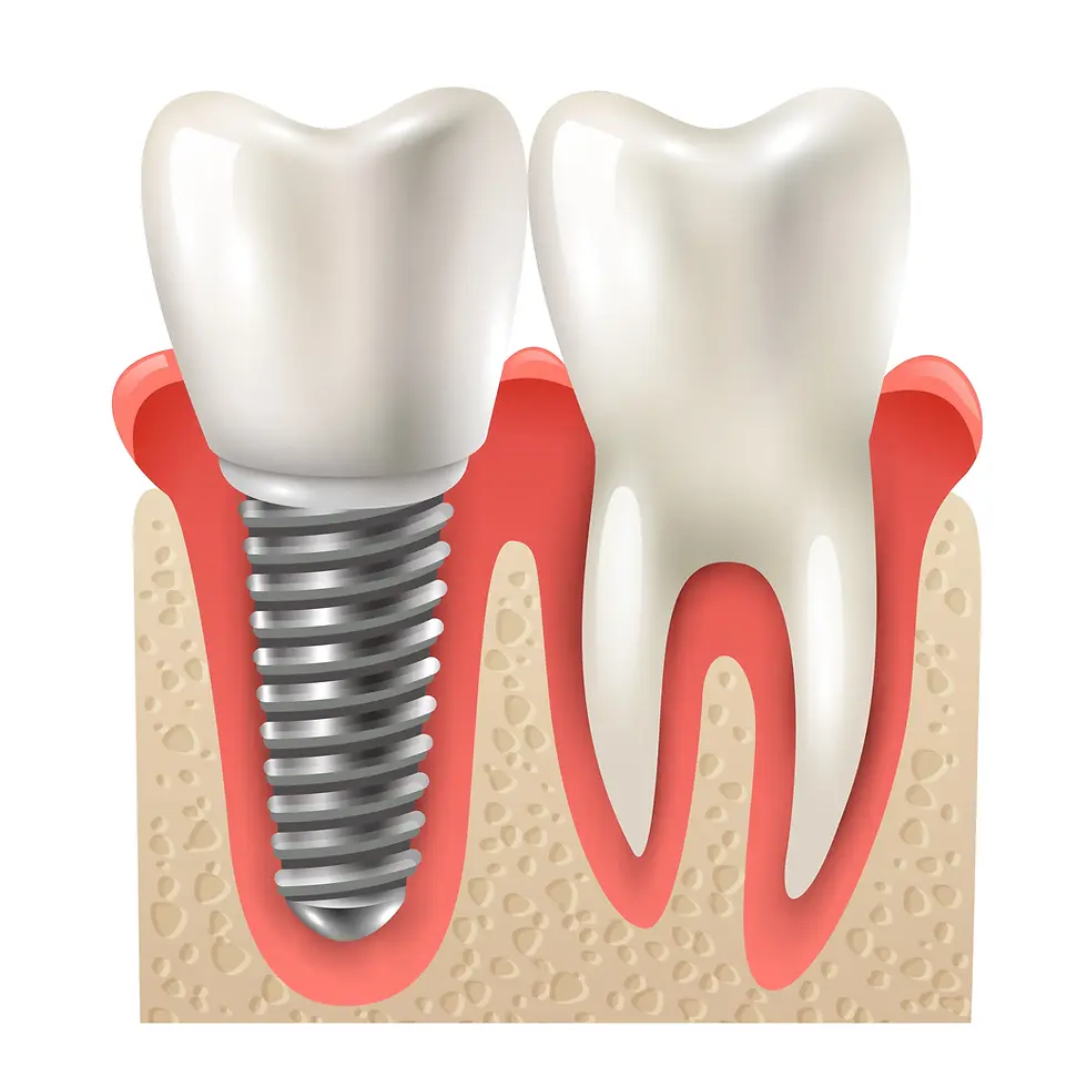 Dental Implants? Why Esthetic Smiles in Kharghar is Right Choice