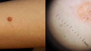 Mole-check-before-and-after-dermoscopy.png