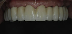 Full arch zirconia dental implants final result Tijuana Mexico