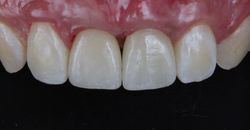 Anterior zirconia implant crowns-final result