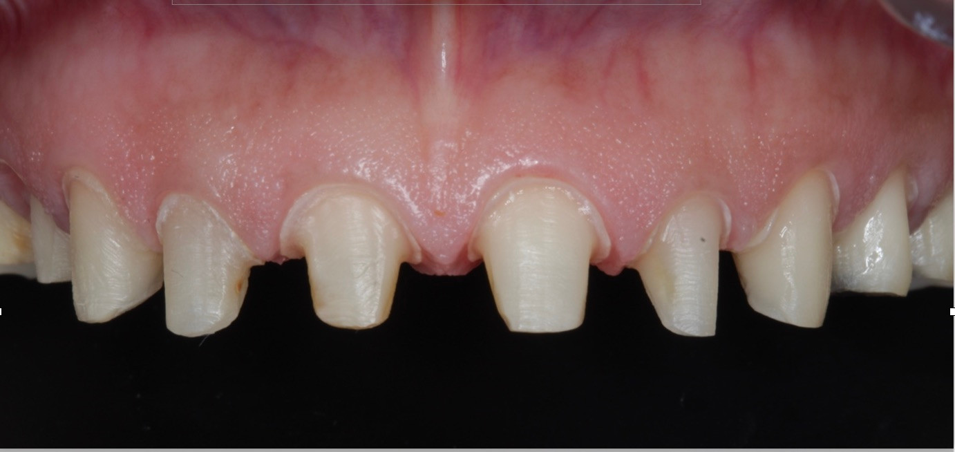 Dental Implants Tijuana Coe Dental Group Tijuana