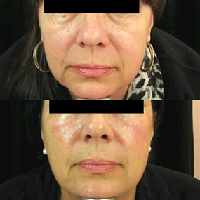Correcting under eyes, cheeks and mid face with Defyne 